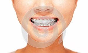 Smile: teeth with braces photo