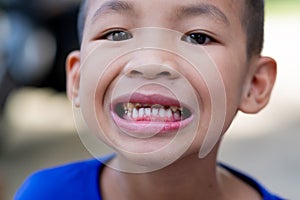 A smiling Asian boy And saw his tooth decay