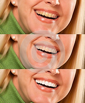 Smiling female showing progressive teeth whitening and bleaching photo