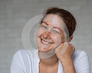 Smiling girl with an autoimmune disease affecting the skin. Portrait of a woman with a pigmented spots of vitiligo on