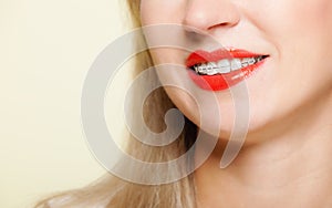 Smiling girl with braces face part teeth straighten, tooth hygiene