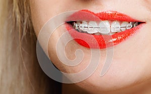 Smiling girl with braces face part teeth straighten, tooth hygiene photo