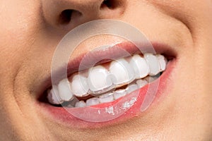 Smiling girl wearing invisible teeth braces photo