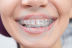 Smiling happy woman mouth with tongue and braces. Orthodontics occlusion correction in dentistry