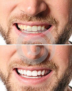 Smiling man before and after teeth whitening procedure