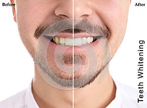 Smiling man before and after teeth whitening procedure on light background