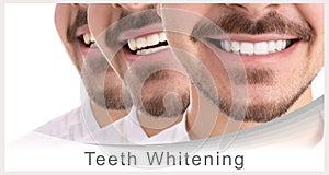 Smiling man before and after teeth whitening procedure