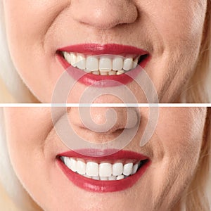 Smiling mature woman before and after teeth whitening procedure