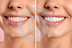 Smiling woman before and after teeth whitening procedure