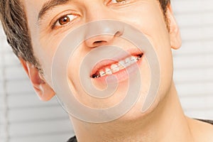 Smiling young man with dental braces