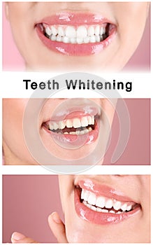 Smiling young woman before and after teeth whitening procedure on color background