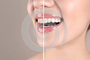 Smiling young woman before and after teeth whitening procedure on color background