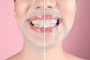 Smiling young woman before and after teeth whitening procedure on color background