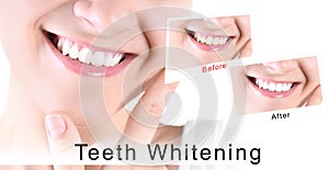 Smiling young woman before and after teeth whitening procedure on light background