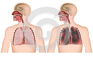 Smoking lung medical  illustration on white background , man with cigerette photo