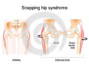 Snapping hip syndrome. Coxa saltans photo