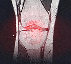 A snapshot of the diagnosis of an MRI of the knee in which arthrosis and arthritis. The concept of joint diagnosis using x-rays,