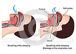 Snoring medical  illustration with description on white background