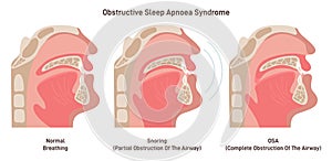 Snoring and OSA. Sleep apnea, snoring syndrome anatony. Partial or complete photo