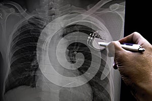 Soft and blurry image chest x-ray film of a patient with cardiac pacemaker, also with congestive heart and cardiomegaly.By surgery