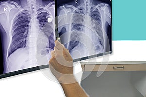 Soft and blurry image chest x-ray film of a patient with cardiac pacemaker, also with congestive heart and cardiomegaly.By surgery