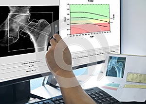 Soft and blurry image Hand doctor point woman`s hip bone mass image The graph has a standard point below Therefore diagnosed with