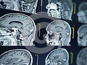 Soft and blurry image MRI brain showing in the LCD moniter ,Medical concept. photo