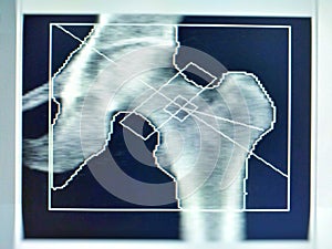 Soft and blurry image: special examination medical image hip bone density on white background. -