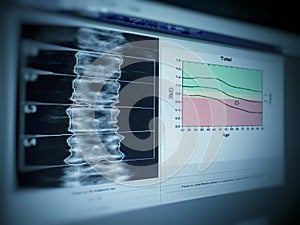 Soft and blurry image: special examination medical image lumbar bone density on white background. - photo