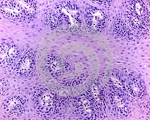 Soft palate papilloma