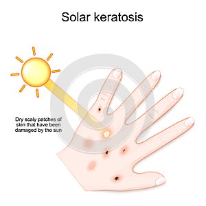 Solar keratosis. Dry scaly patches of skin