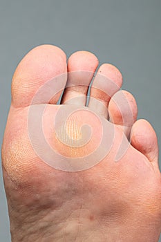 Sole of a female foot with thick calluses due to heels