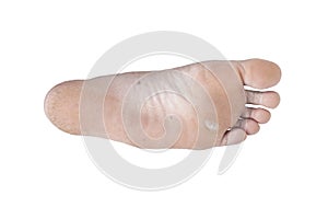 The soles of the feet have hard corns or callus and dry cracks isolated on white background.