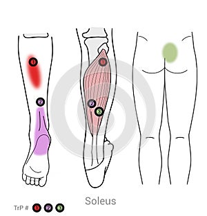 Soleus: Treating myofascial trigger points in the Soleus calf muscle