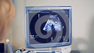 Sonography monitor with an image of a fetus. Medical ultrasound scan.