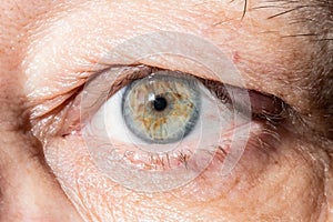 Sore eye with thickening on eyelid from chalazion