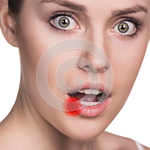 Sore on the female lips photo