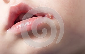 Sore on the lip of the child herpes