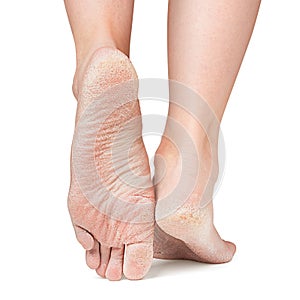 Sore skin of feet, crack, dry heels