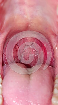 Sore throat inside the mouth, closeup. Diseases of the throat and mucous membrane, redness of the throat and tonsils