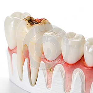 A sore tooth amidst healthy teeth isolated on transparent background photo