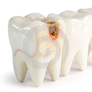 A sore tooth amidst healthy teeth isolated on transparent background photo