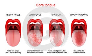 Sore or white tongue. comparison of healthy tongue and oral disease photo