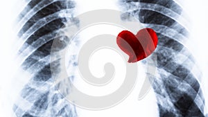 Souvenir red heart lies on the chest X-ray. Fluorography and Valentine`s Day in medicine. Concept of heart surgery or cardiac