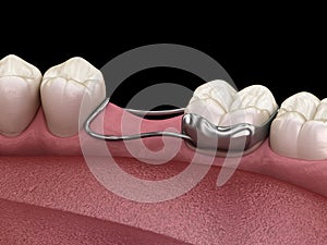 Space Maintainer Unilateral keeps from teeth shift deformatiuon after losing molar tooth. 3D illustration