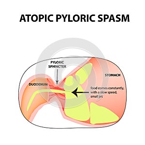 Spasms of the pylorus. Pylorospasm. atonic. Pyloric sphincter of the stomach. Infographics. Vector image on isolated background photo