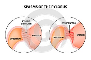 Spasms of the pylorus. Pylorospasm. Spastic and atonic. Pyloric sphincter of the stomach. Infographics. Vector