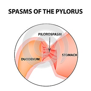 Spasms of the pylorus. Pylorospasm. Spastic and atonic. Pyloric sphincter of the stomach. Infographics. Vector image photo