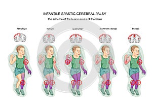 Spastic infantile cerebral palsy