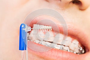 Special interdental brush for braces photo